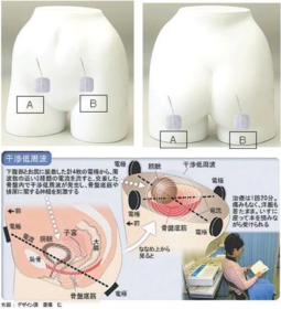 ウロマスター装着例の写真